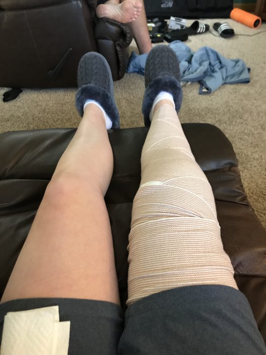 leg after IT band knee surgery with ACE wrap on entire leg