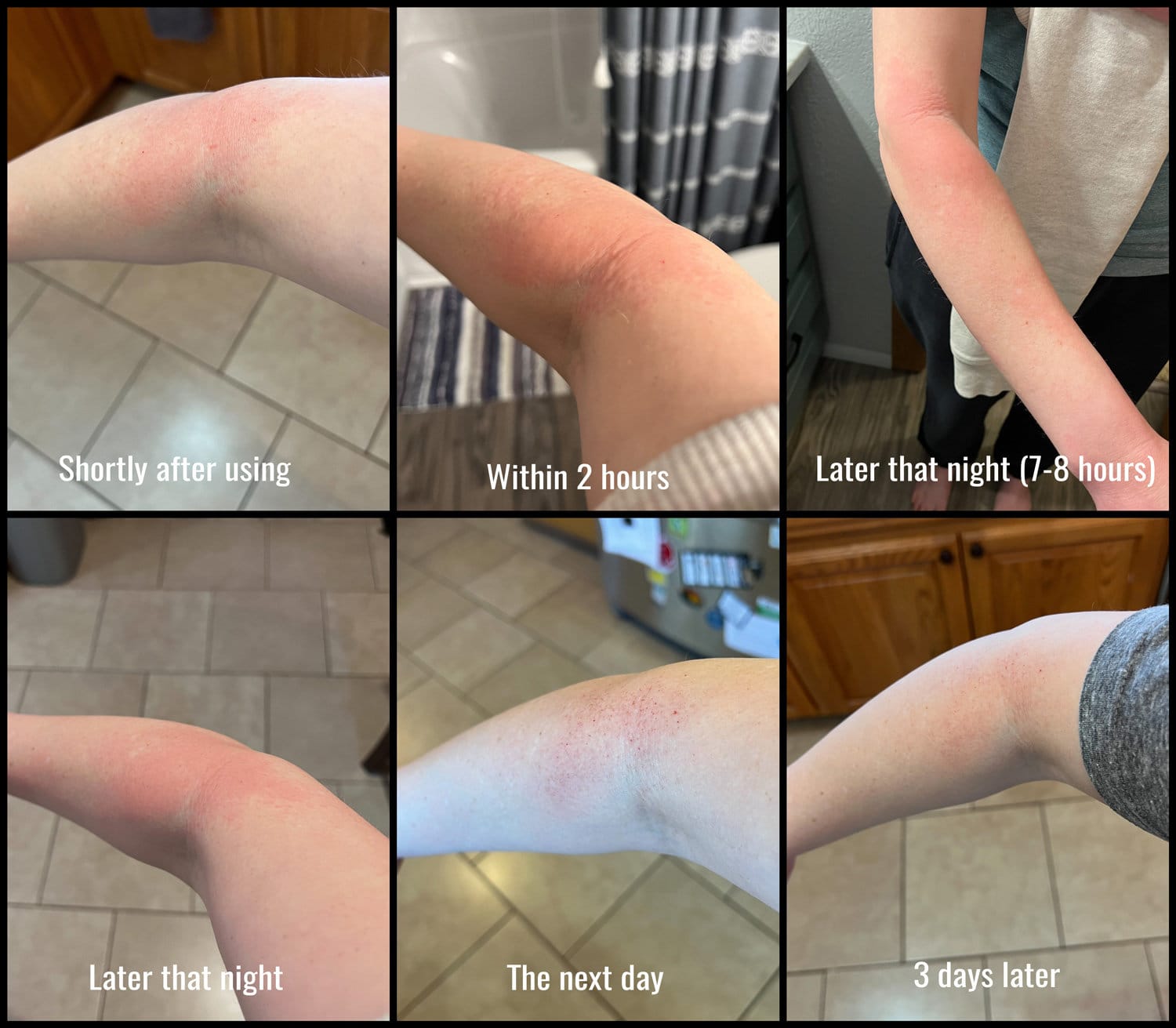 photo collage showing skin injury from crystal hair eraser/crystal hair remover. 